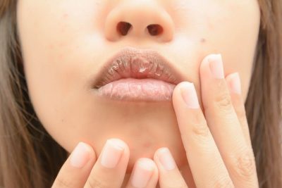 Boca seca: o que é, causas, sintomas e como tratar corretamente