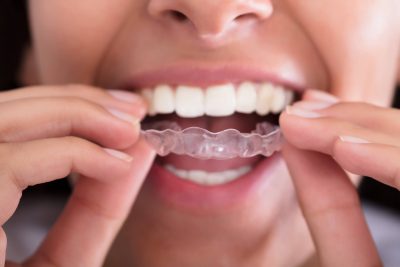 Os riscos do clareamento dental sem orientação